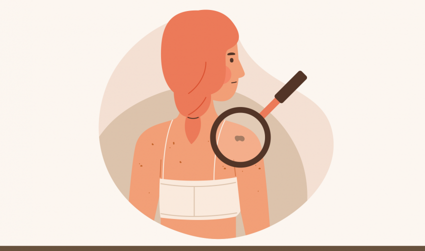 PREVENÇÃO DO MELANOMA NA UBS CIDADE ALTA