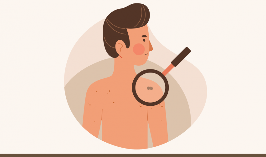 PREVENÇÃO DO MELANOMA NA UBS ITAMARATI