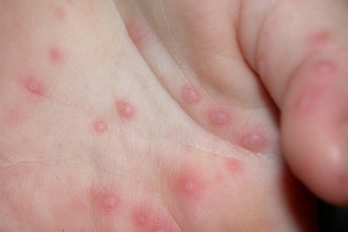 Vigilância Epidemiológica: orientações sobre síndrome mão-pé- boca