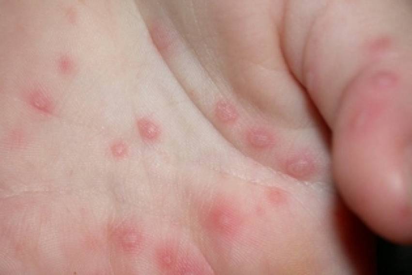 Vigilância Epidemiológica: orientações sobre síndrome mão-pé- boca