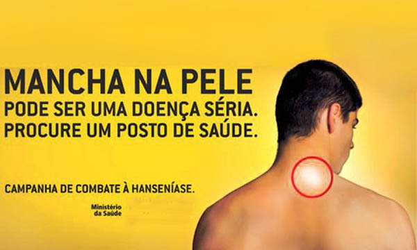 Secretaria de Saúde faz campanha de conscientização sobre a hanseníase