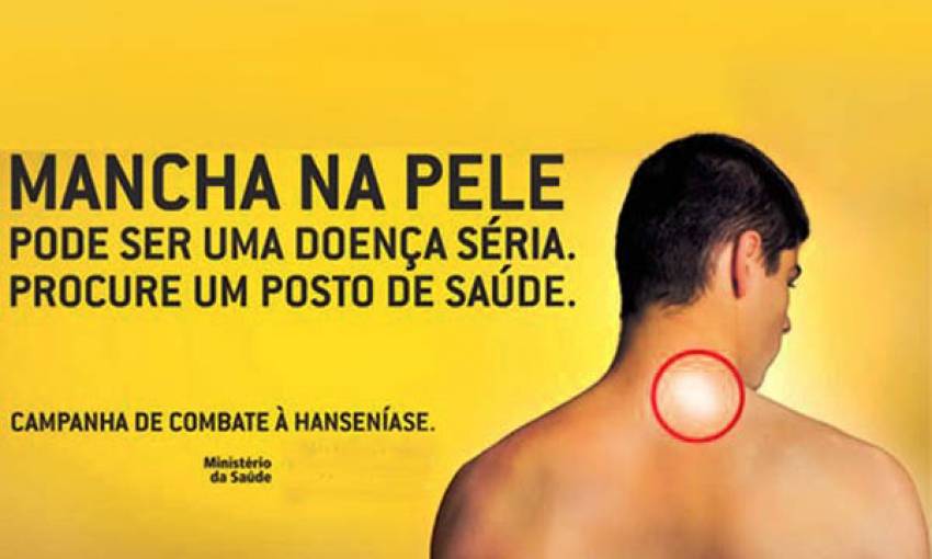 Secretaria de Saúde faz campanha de conscientização sobre a hanseníase